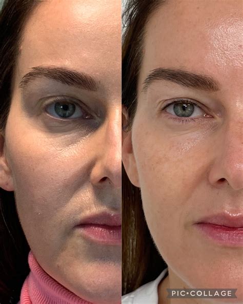 Venus Viva™ MD treatment .